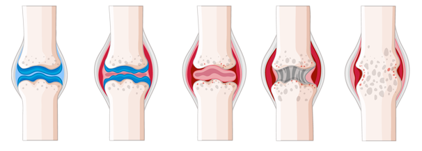 健康關節缺氨糖易受損 御正君骨活丸 持續養護