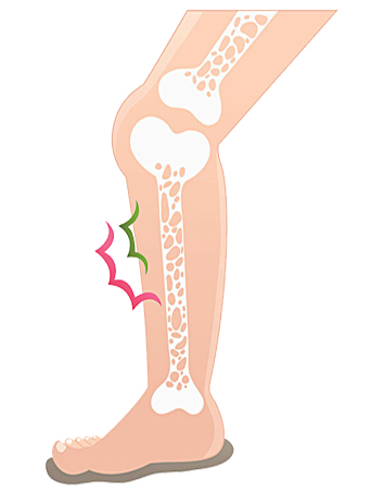 骨質疏鬆風險 / 骨密度下降人群 御正君骨活丸 預防改善